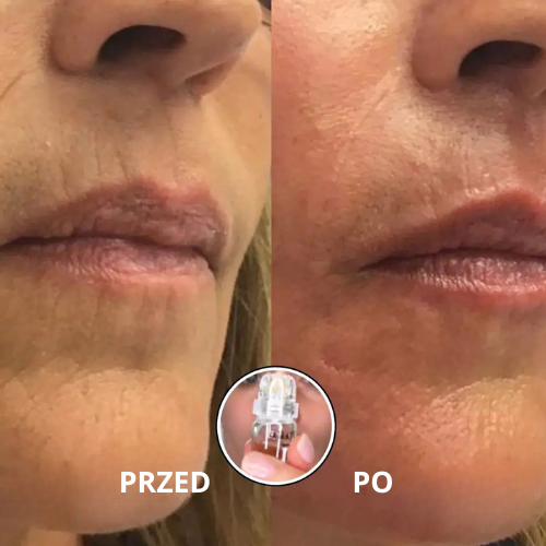 Serum mikroinfuzja twarzy RENEWAL™